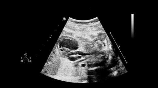 Fetal echocardiography is a diagnostic method for congenital heart defects.