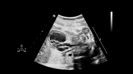 Fetal echocardiography is a diagnostic method for congenital heart defects.